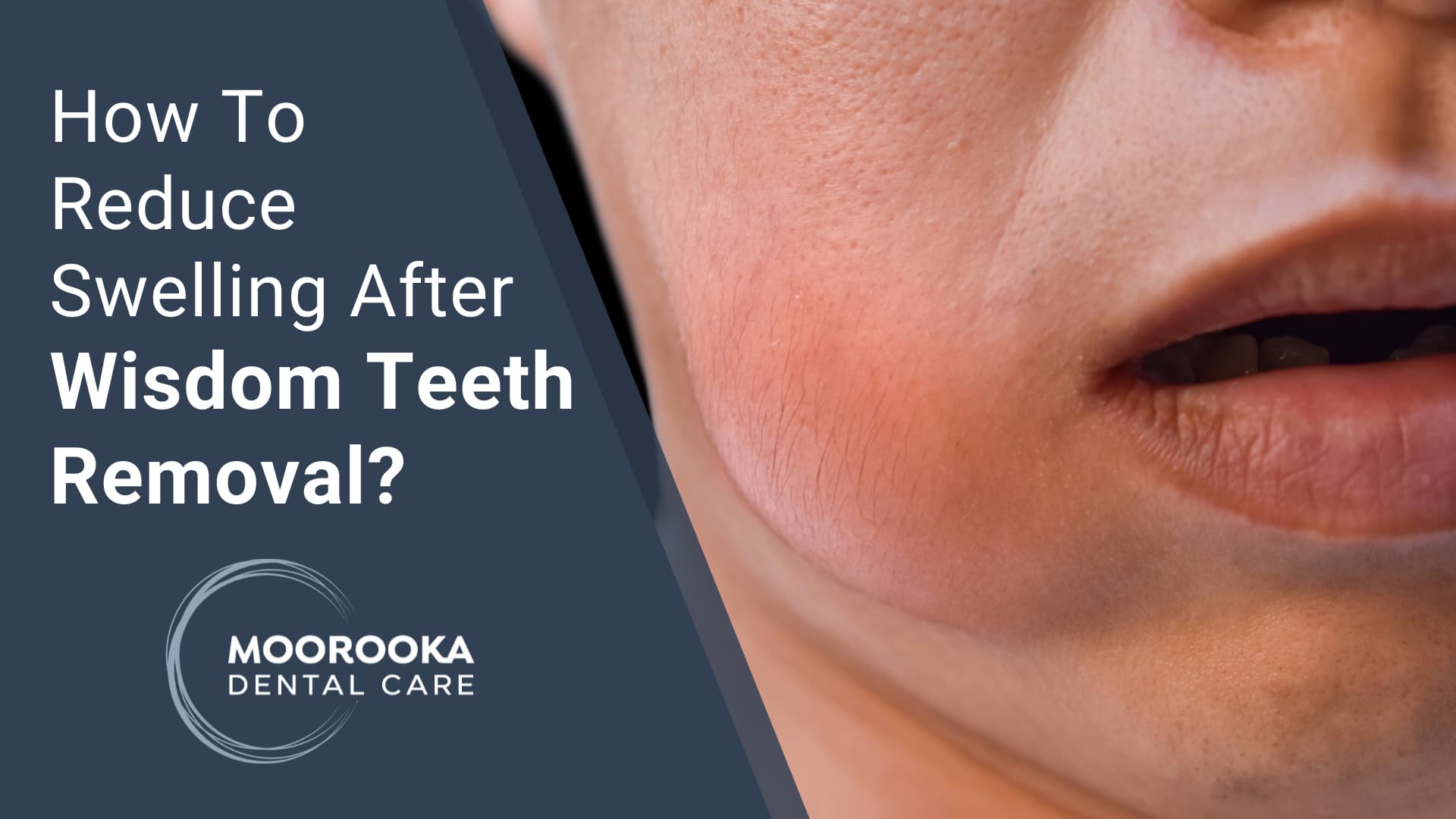How To Reduce Swelling After Wisdom Teeth Removal?